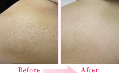 症例写真 | 脱毛・医療レーザー脱毛なら美容外科、美容整形の ...