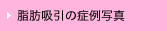 脂肪吸引の症例写真