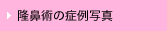 隆鼻術の症例写真