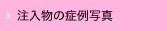 注入物の症例写真