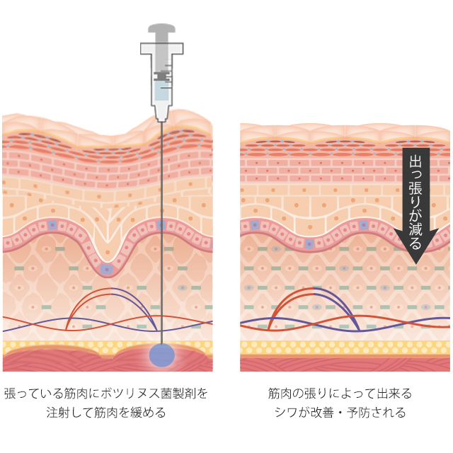 ボトックス注射