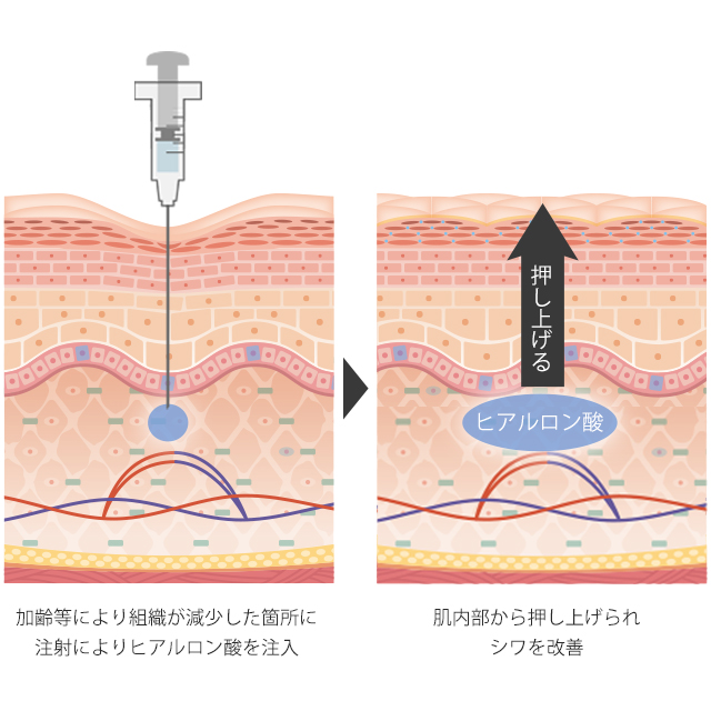 ヒアルロン酸注入