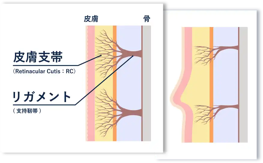 リガメント (支持靭帯) のゆるみ
