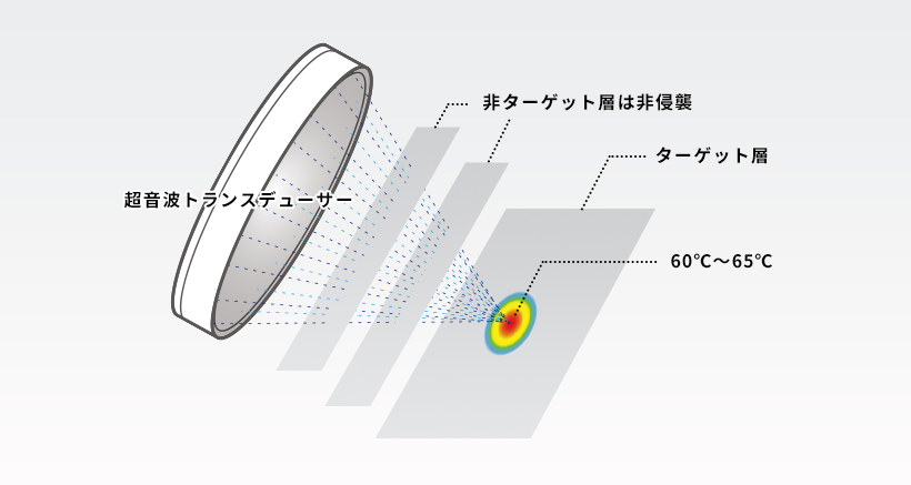 HIFUでたるみが改善する仕組み