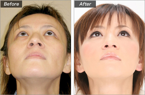 フェイスリフト(城本クリニック看護師) の症例写真