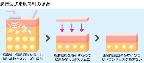 超音波式脂肪吸引の場合