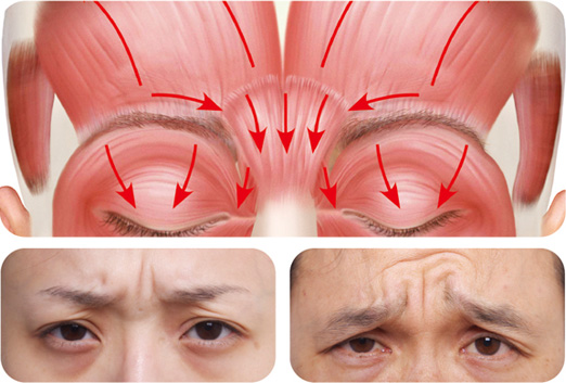 シワ 額 眉間 目尻 への注入 ボトックス注入なら城本クリニック