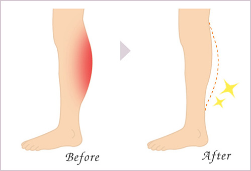 ふくらはぎ痩身 筋肉 への注入 ボトックス注入なら城本クリニック