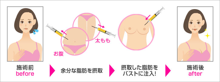 脂肪注入法 施術図解