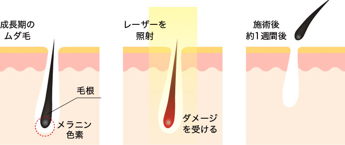 レーザー脱毛の仕組み