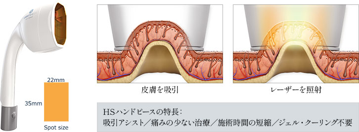 ライトシェア HSハンドピース