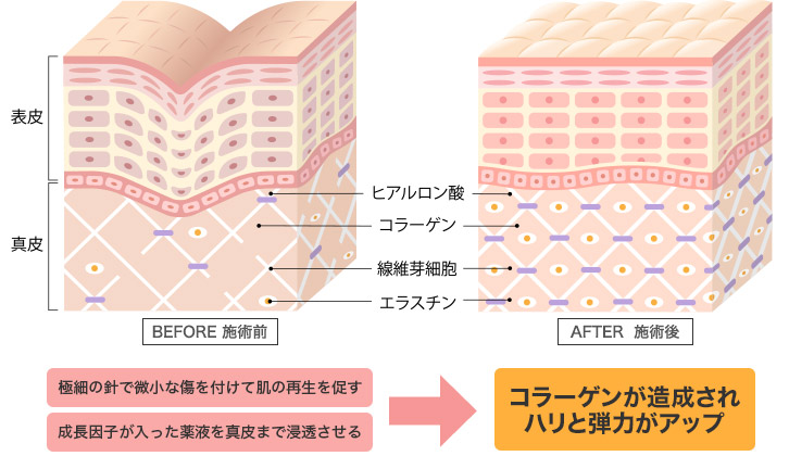 ダーマローラーを使用する事で真皮に起こる反応