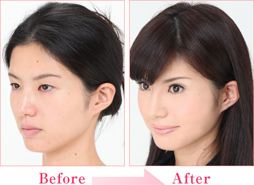 上原かな さん 私も綺麗になりました 二重まぶた 目の整形なら城本クリニック 上原かな さん 私も綺麗になりました 二重まぶた 目の整形なら城本クリニック