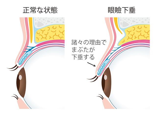 眼瞼下垂とは