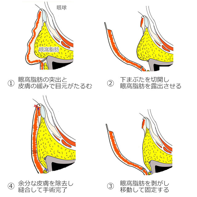 ハムラ法解説