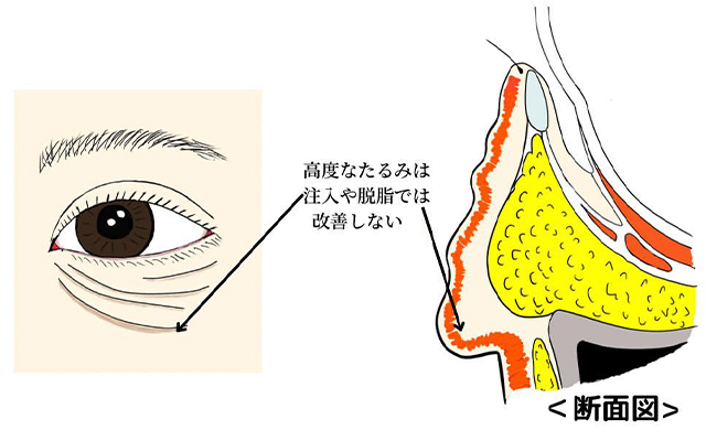 下眼瞼切開法適応