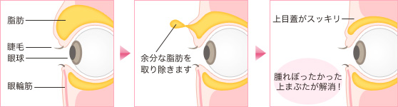 まぶた の 脂肪 取り