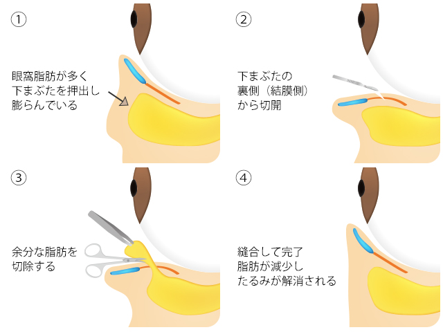 下眼瞼部脱脂・結膜側