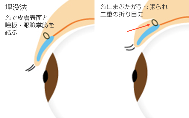 埋没法の構造