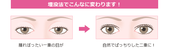 目 埋没法 二重埋没法の二回目手術を受ける前に知っておきたいリスク｜共立美容外科 札幌院