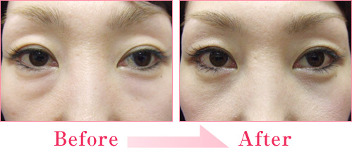 目の下 下まぶたのたるみ取りなど目元の整形なら城本クリニック