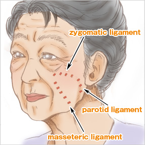 フェイスリフトとは