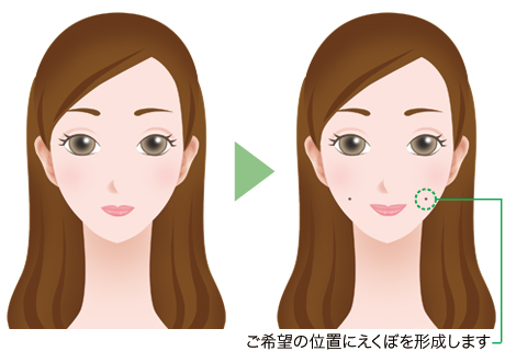 えくぼ形成の手術方法