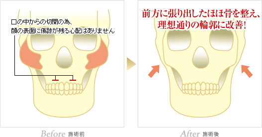 施術前:口の中からの切開の為、顔の表面に傷跡が残る心配はありません。施術後:前方に張り出したほほ骨を整え、理想通りの輪郭に改善！