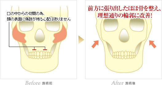 ホホ削り 輪郭形成なら城本クリニック