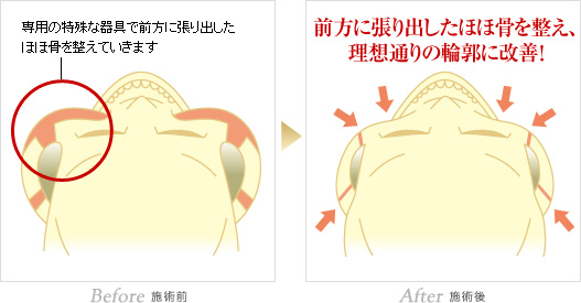 ホホ削り 輪郭形成なら城本クリニック