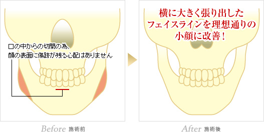 施術前:口の中からの切開の為、顔の表面に傷跡が残る心配はありません。施術後:横に大きく張り出したフェイスラインを理想通りの小顔に改善！