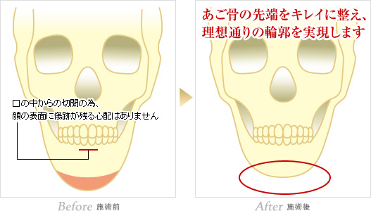 施術前:口の中からの切開の為、顔の表面に傷跡が残る心配はありません。施術後:あご骨の先端をキレイに整え、理想通りの輪郭を実現します。