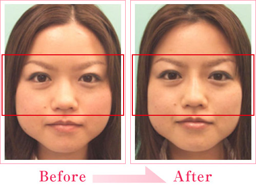 鼻への注射 ヒアルロン酸注入なら城本クリニック