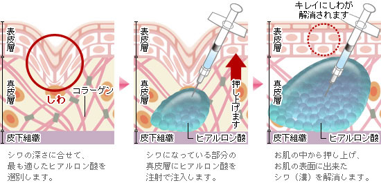 step1. シワの深さに合わせて、適切なヒアルロン酸を選別します。step2. シワになっている部分の真皮層にヒアルロン酸を注射で注射します。step3. お肌の中から押し上げ、お肌の表面に出来たシワ（溝）を解消します。