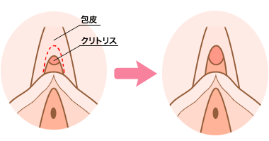 クリトリス包茎の治療イメージ