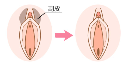 副皮切除術の治療イメージ