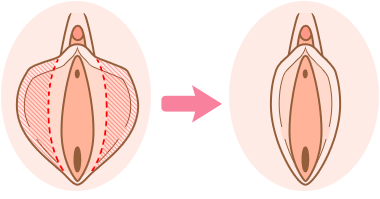 小陰唇縮小の治療イメージ