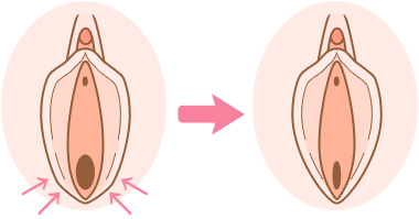 膣縮小の治療イメージ