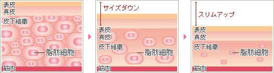 脂肪溶解注射によるスリムアップ