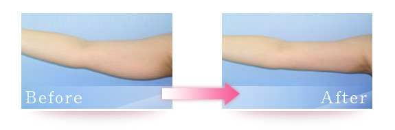 メソセラピー脂肪溶解注射 の症例写真