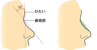 I型プロテーゼ