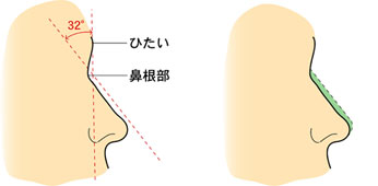 L型プロテーゼ