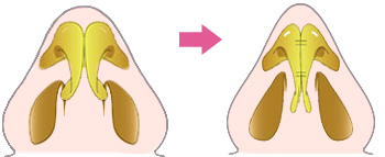 鼻尖形成術（軟骨の形成により鼻先を小さくする）
