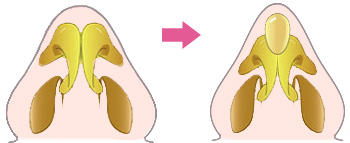 鼻尖形成術（プロテーゼ、軟骨移植により鼻先を小さくする）