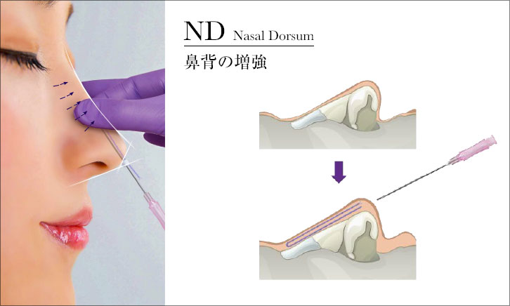 ND 鼻背のボリュームアップ