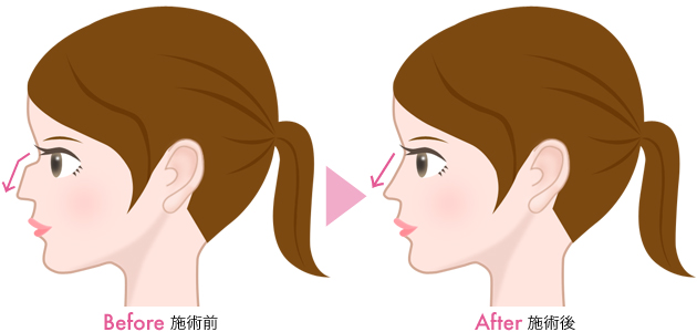 その他の手術 隆鼻術 鼻の整形なら城本クリニック