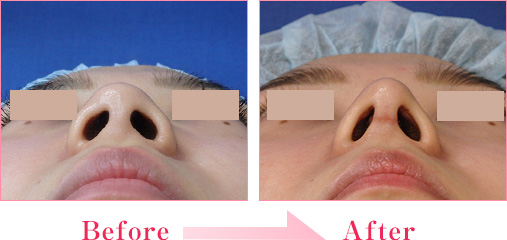 鼻中隔延長術 隆鼻術 鼻の整形なら城本クリニック
