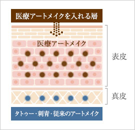 医療アートメイクとは