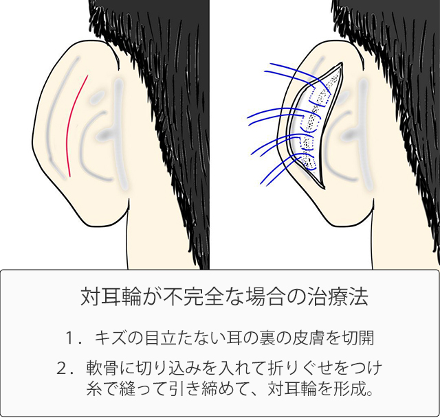 対耳輪の形成