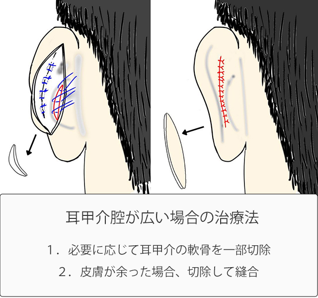 耳甲介が大きい場合の治療法